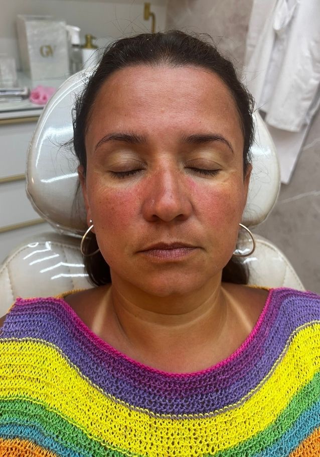 Pele antes do Derma Reset