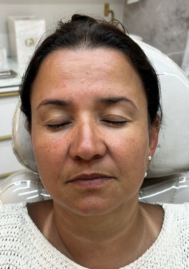 Pele 48 horas após o Derma Reset