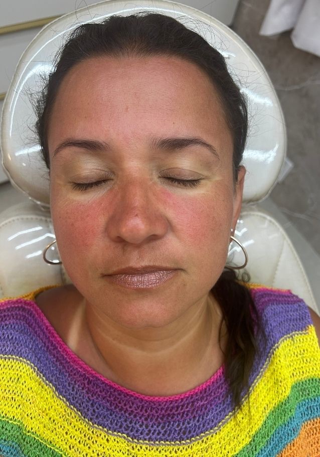 Pele imediatamente após o Derma Reset